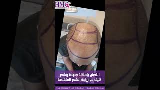 تقنيات زراعة الشعر الحديثة : السر وراء الشعر الطبيعي . @HMC_Beauty