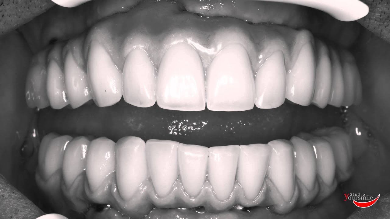 Protesi completa superiore ed inferiore su impianti