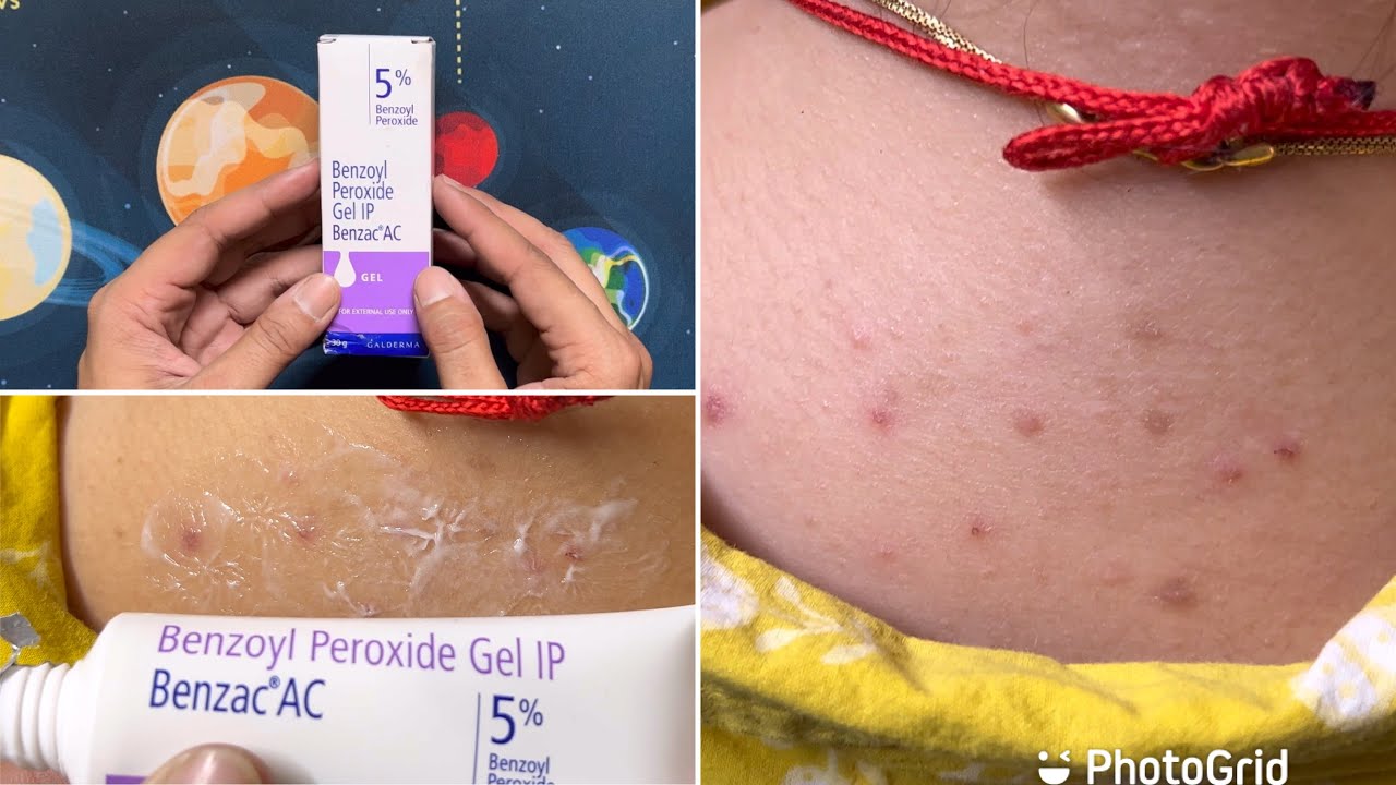 Benzoyl Peroxide Gel IP 5%| Benzac AC Review,Uses & Side Effects | Best ...