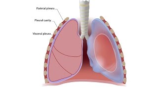 Akciğer Zarında Sıvı Birikmesi Plevra Efüzyonu Nedir?