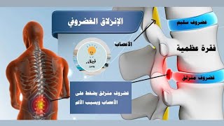 ما هو الانزلاق الغضروفي وأفضل طريقة علاج مع الدكتور جوده