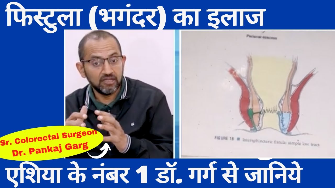 What is Anal Fistula। भगंदर का कारण, लक्षण, इलाज जानिये एशिया के नंबर वन डॉक्टर से। Dr Pankaj Garg