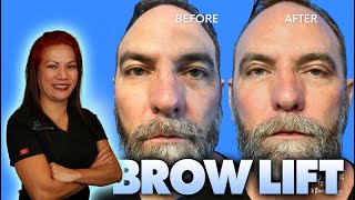 Celebrity Male Brow Lift - Age 49 Profile