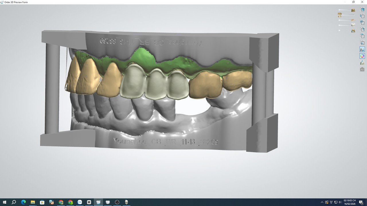 Designing a Crown oral scan in 3Shape, custom-designed based on client requirements