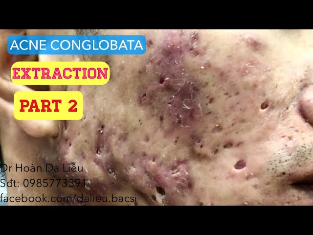 Mụn trứng cá mạch lươn nặng|Dermatologist, pimples,whitehead blackhead, acne conglobata extraction 2