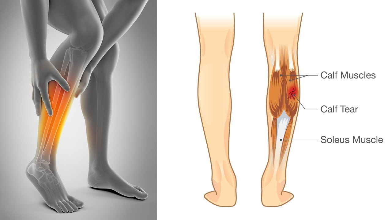 Боль в икрах ног у мужчин. Судорога икроножной мышцы. Судороги в ногах икроножные мышцы. Спазм мышц икроножной мышцы.