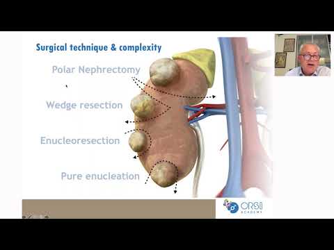 Urowebinar: Update on robot assisted partial nephrectomy