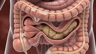 How Constipation Get Stuck Inside The Intestine | Gut Health| BODY ARTS ANATOMY 3D  is live!