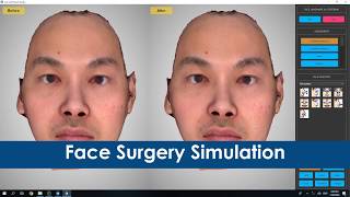 Rapid High Fidelity 3D Face Scanning System and 3D Face Surgery Simulation