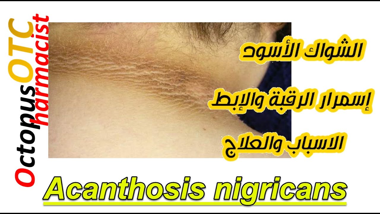 OTC | AN | الشواك الاسود | اسمرار الرقبة والابطين | تفتيح البشرة | كلف الحمل | كلف الوزن الزائد