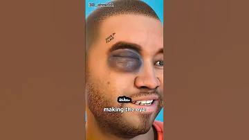 ماذا يحدث عندما تتعرض لضربة في العين بصريات Eyes عيون فحص النظر 