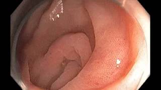 Colonoscopy Channel - Subtle lesion at the mouth of appendix