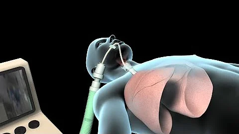 ¿Qué es un tubo respiratorio en la UCI?