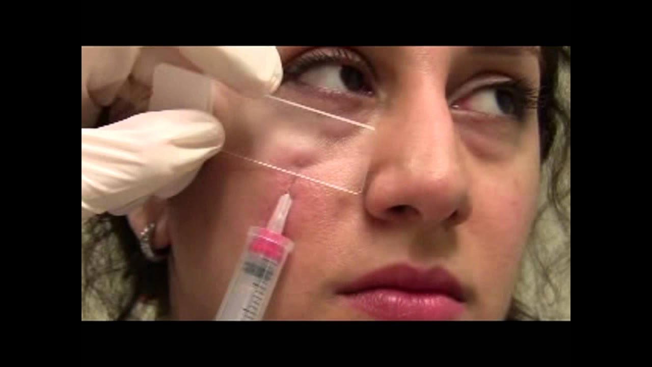 Acne Papule Injection Youtube