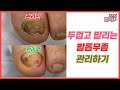 발톱속에 물집이😵 케어하는데 물이나와요😭 제발 빨리들 오셔요🙏🏻