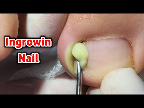 شاهد كيف يتم علاج الضفر الغائر الضفر المغروس في اللحم  