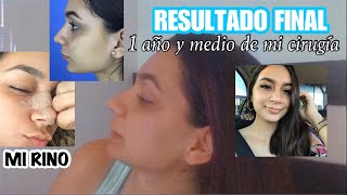 MI RIN0PLASTIA: ACTUALIZACIÓN FINAL | 1 año después❤️👃