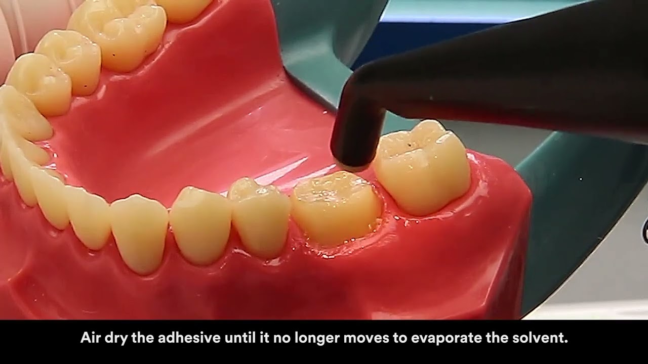 3M RelyX Ultimate automix cementation glass ceramic tack cure