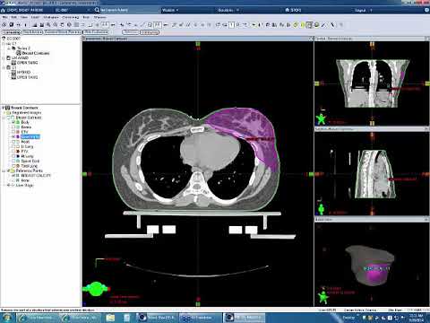 IMRT® સારવાર Eclipes TPS નો ઉપયોગ કરીને સ્તન કેન્સર માટે આયોજન ટિપ્સ