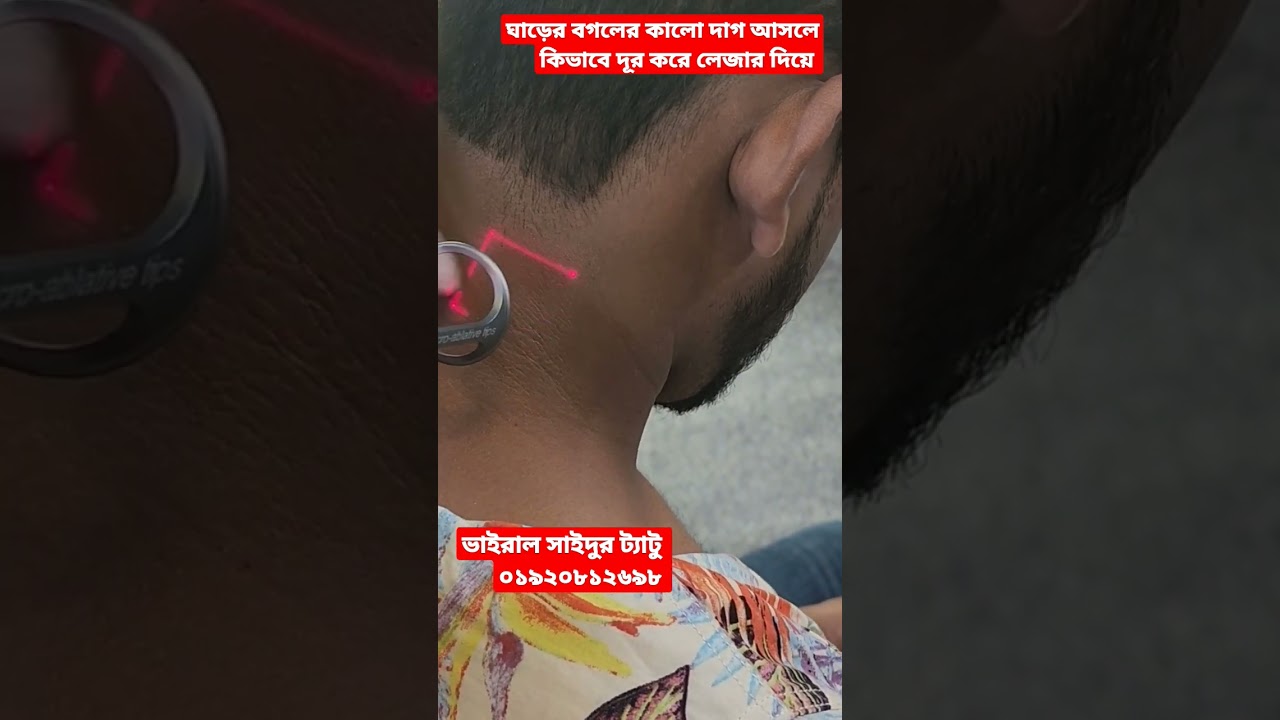 আপনাদের ঘাড়ের /বগলের /গলার নিচের / চোখের চারপাশের কালো দাগ আসলে কিভাবে লেজার দিয়ে দূর করে #shorts