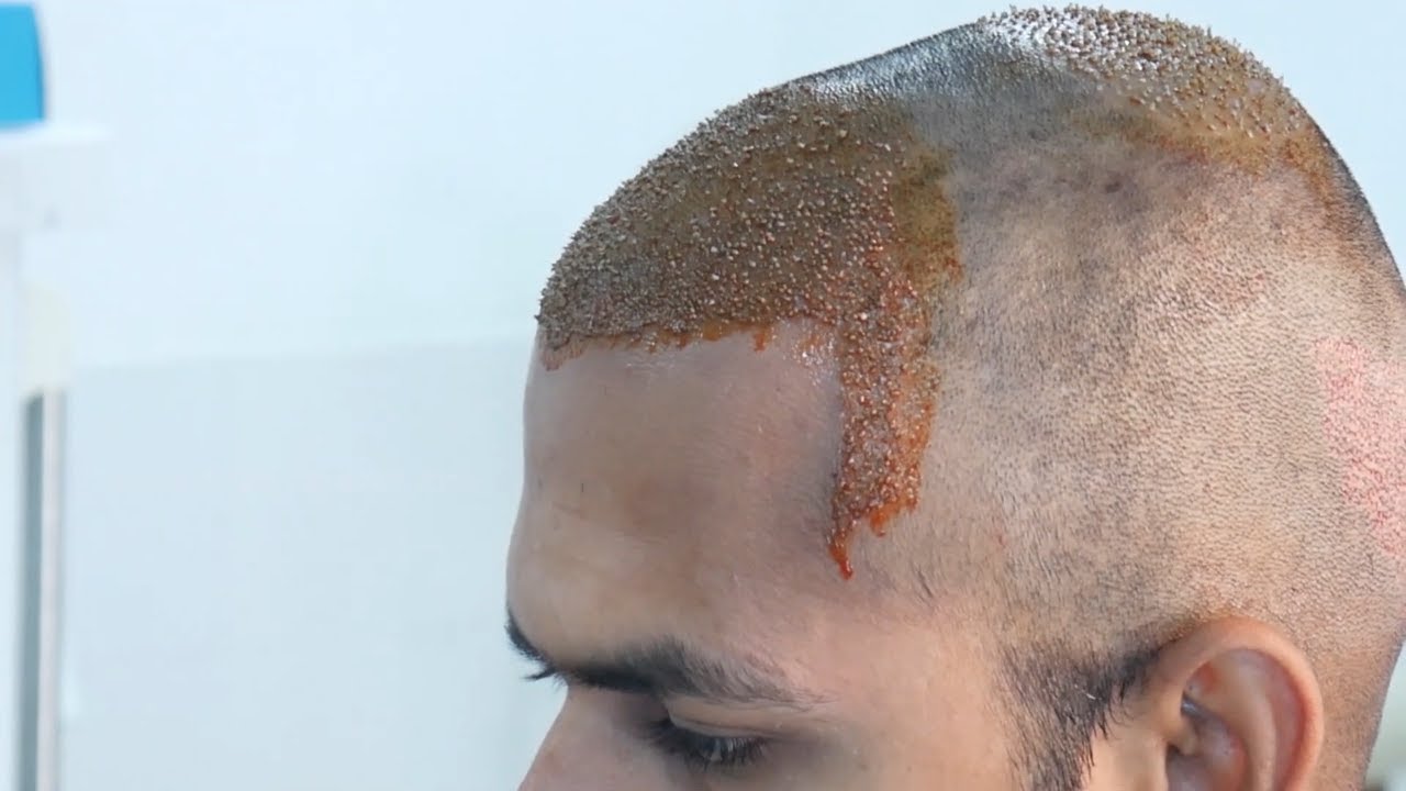 A Bald Man Gets A Life Changing Hair Transplant YouTube