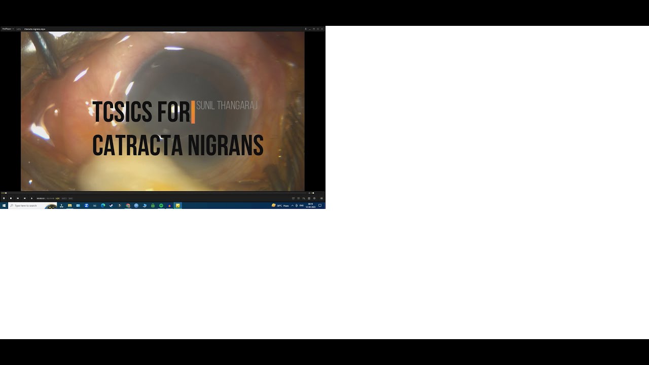 Cataract nigrans - TCSICS