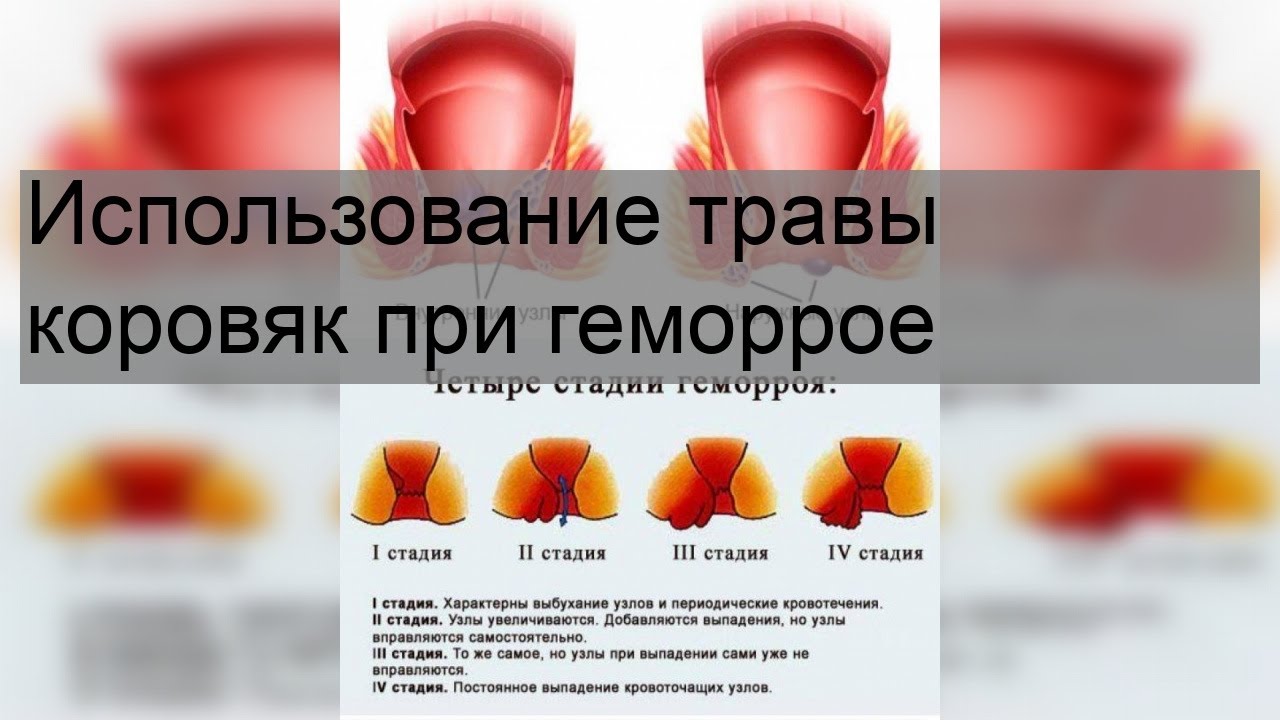 Использование травы коровяк при геморрое