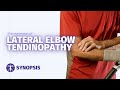 Management of Lateral Elbow Tendinopathy