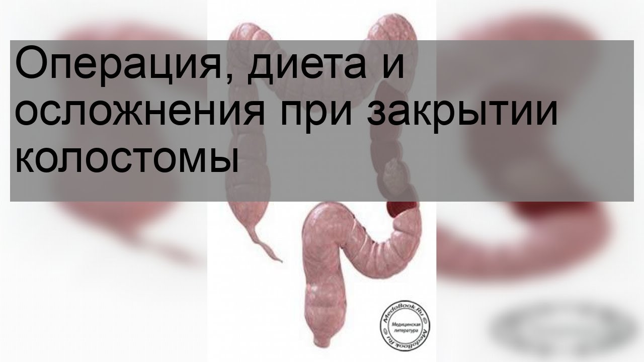 Операция, диета и осложнения при закрытии колостомы