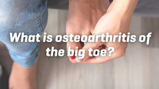What is osteoarthritis of the big toe?