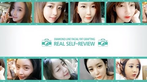 Fresh Review on Fat Graft