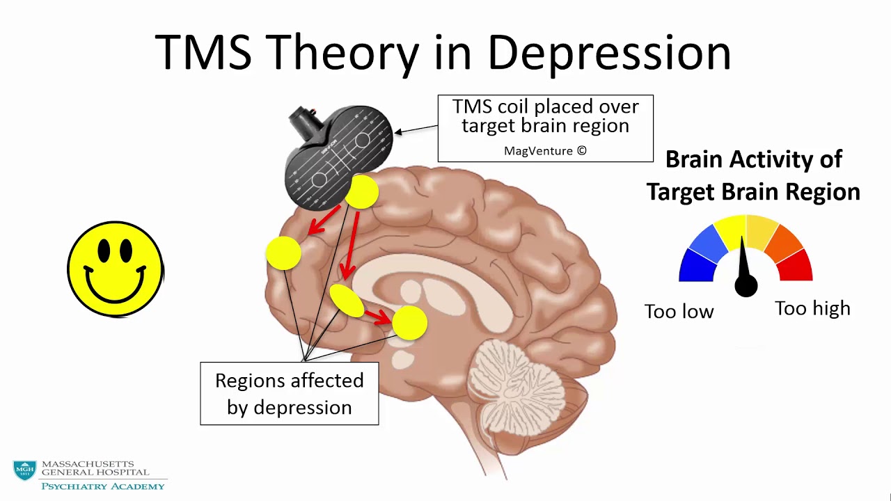 Transcranial A New Treatment for Psychiatric Disorders - YouTube