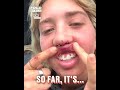 This is why you shouldn't use a DIY lip filler kit 😱🫣