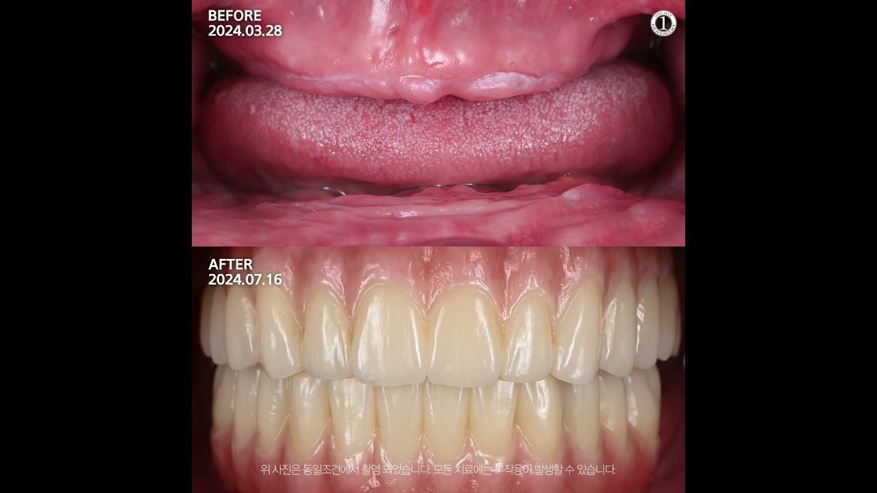 [Phòng khám nha khoa Won-day] Tổng quan về cấy ghép Implant hoàn chỉnh chỉ với 3 lần đến khám Before&After #dentist #doctor #dentalclinic #implants #implantdentistry