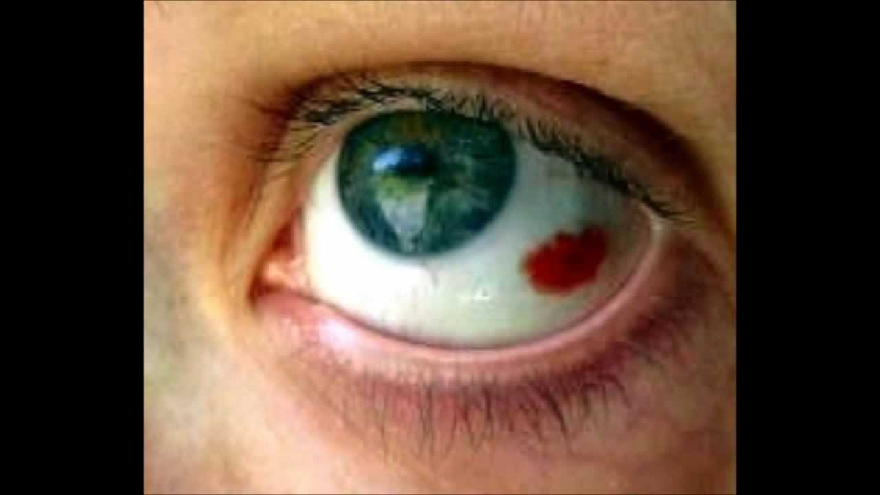 Red Spot On My Eye Youtube