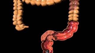 Cook Evolution duodenal & Colonic Animation stent placement
