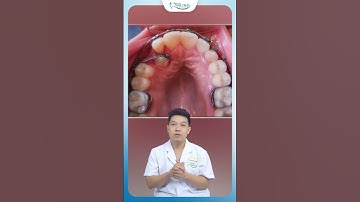 Hành Trình 12 Tháng Kéo Răng Mọc Ngầm | Nha Khoa Minh Châu