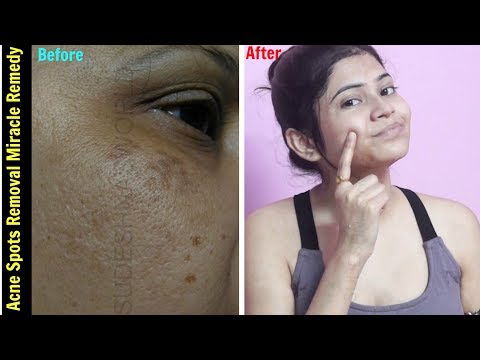Miracle Acne Scars Removal Treatment | Remove DARK SPOTS , BLACK SPOTS & ACNE SCARS | % Effective