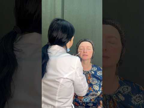 Заполнение носощечной,носослезной борозд и щечки яблочки#косметологростов