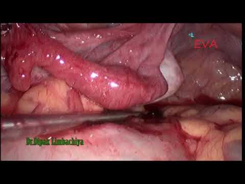 salpingectomy laparoscopic