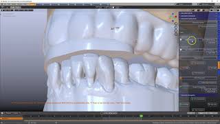 B4D Splint