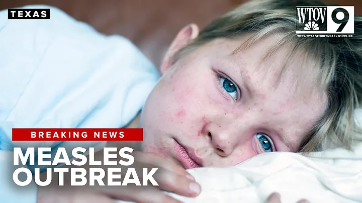 Measles exposure alert issued for Texas after visitor tests positive