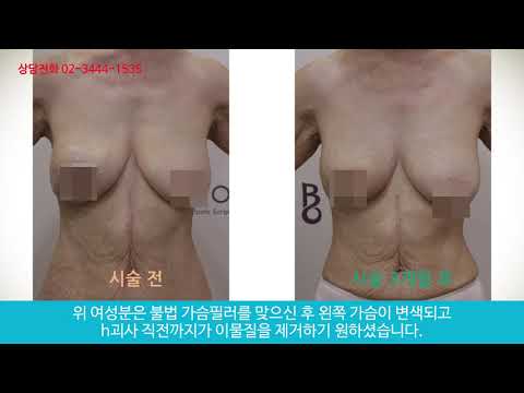 60대 여성 불법 가슴필러 부작용으로 인한 이물질 제거 ( Eliminate side effects of breast molding )