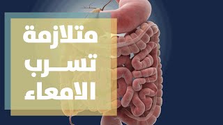 متلازمة تسرب الامعاء  leaky gut