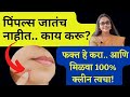 या 7 कारणांमुळे pimples येतात. जाणून घ्या, मुरूम, वांग यावर रामबाण उपाय. Know Your Acne Problems
