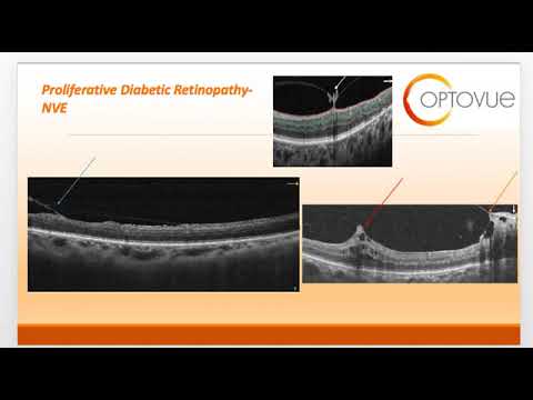 OCT Interpretation Session 4 Retinal Vascular Disease - YouTube