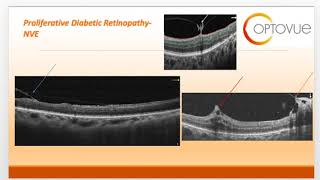 OCT Interpretation Session 4 Retinal Vascular Disease