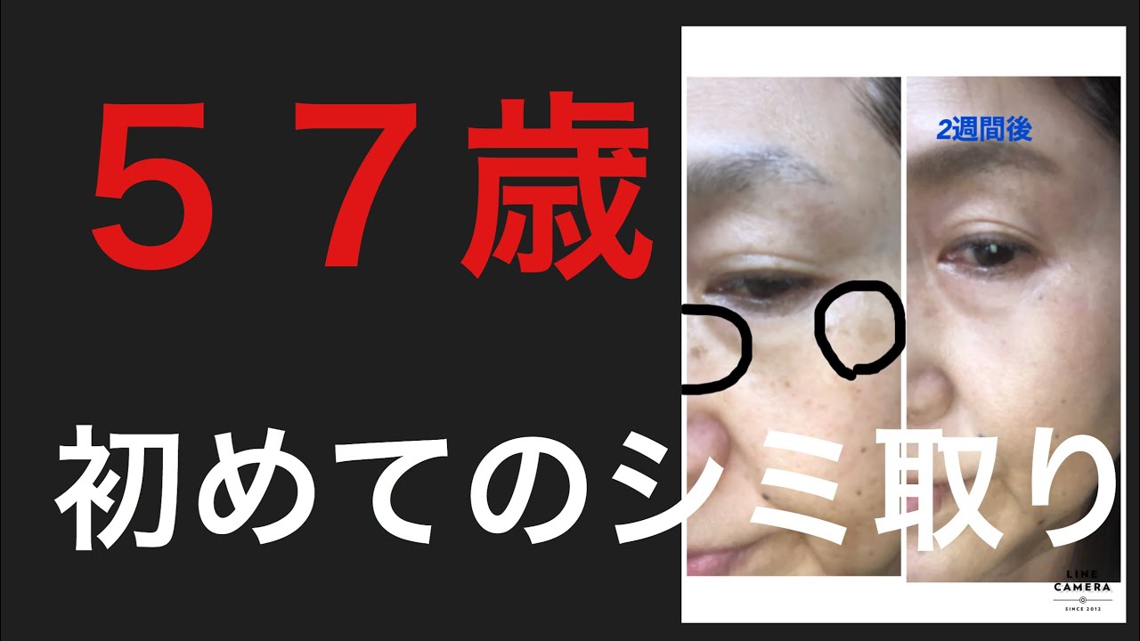 50代初シミ取り行ってみたら Youtube