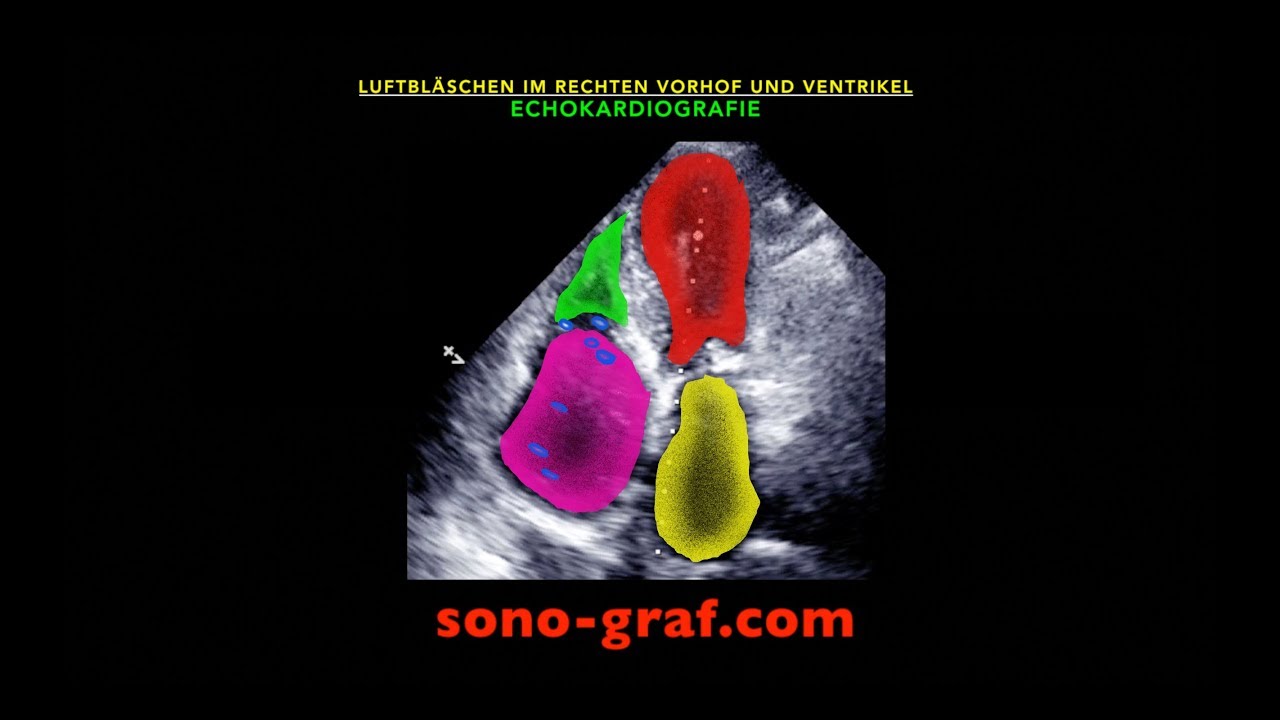 Echokardiografie - Luftbläschen im rechten Vorhof und Ventrikel - YouTube