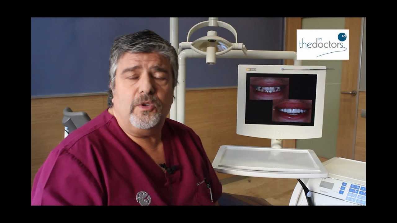 Dr. Fernando Autran - Estética dental con Carillas de Composite top movies on netflix